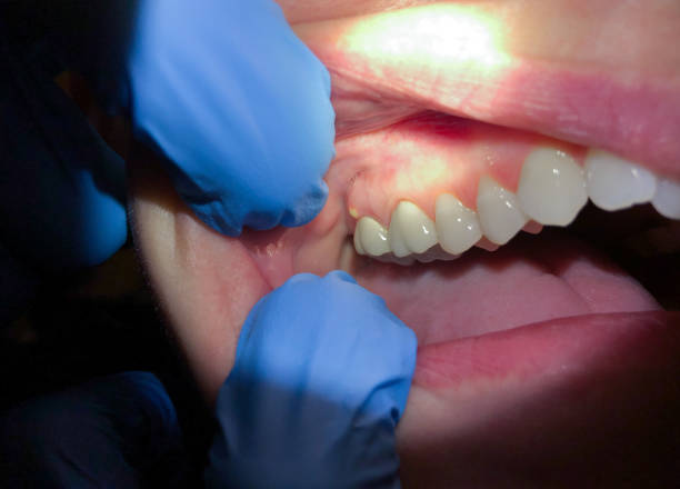 Best Emergency Treatment for Dental Infections or Abscesses in Margaret, AL
